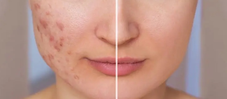 Acne scar treatment laser subcision RF microneedling combination Seoul Korea Gangnam